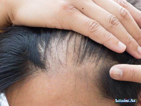 Alopesiya – Saç tökülməsi - LoaDinG.Az