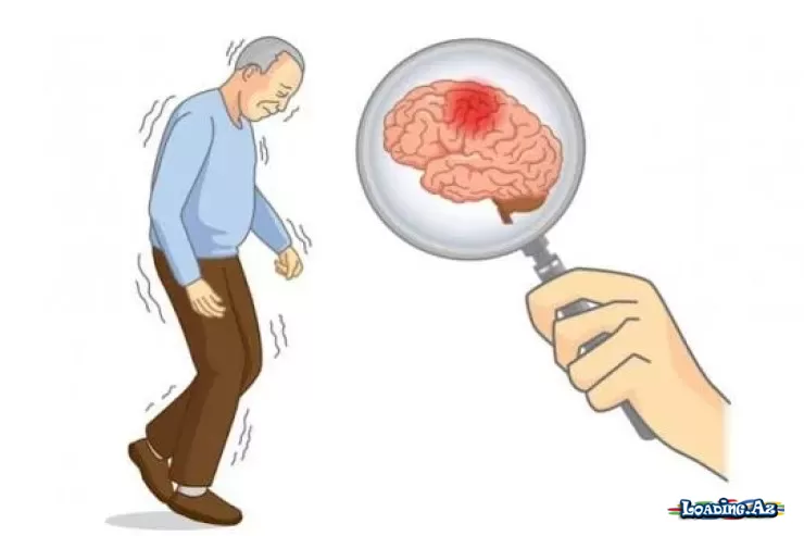 Parkinson xəstəliyi beyində belə yayılırmış - LoaDinG.Az